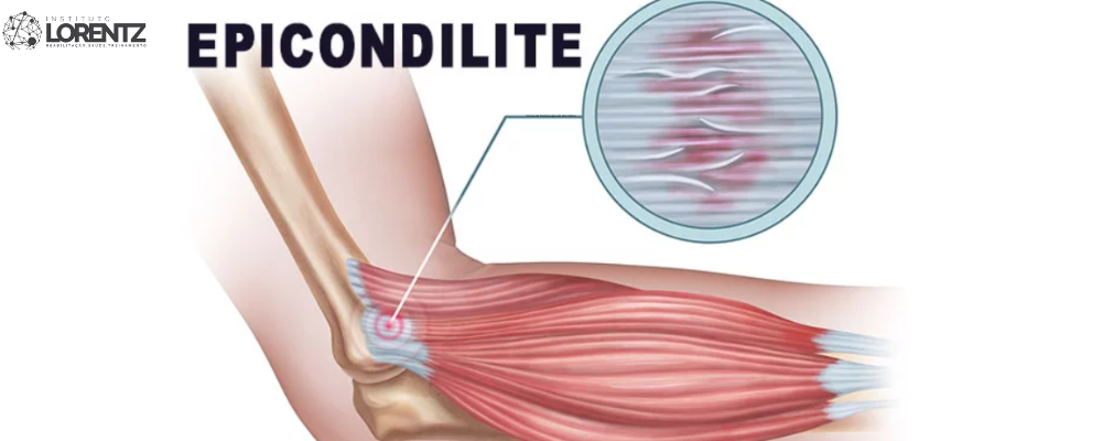Epicondilite: entenda a dor no cotovelo e como tratar 4 Epicondilite e inflamação no cotovelo