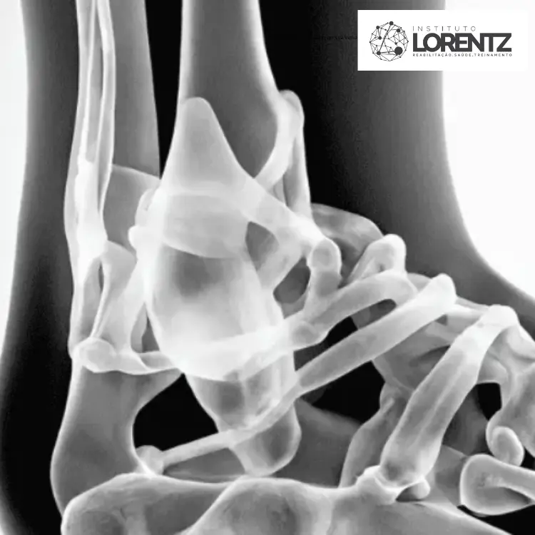 Fisioterapia em Vila Velha - Instituto Lorentz 8 Fisioterapia de tornozelo