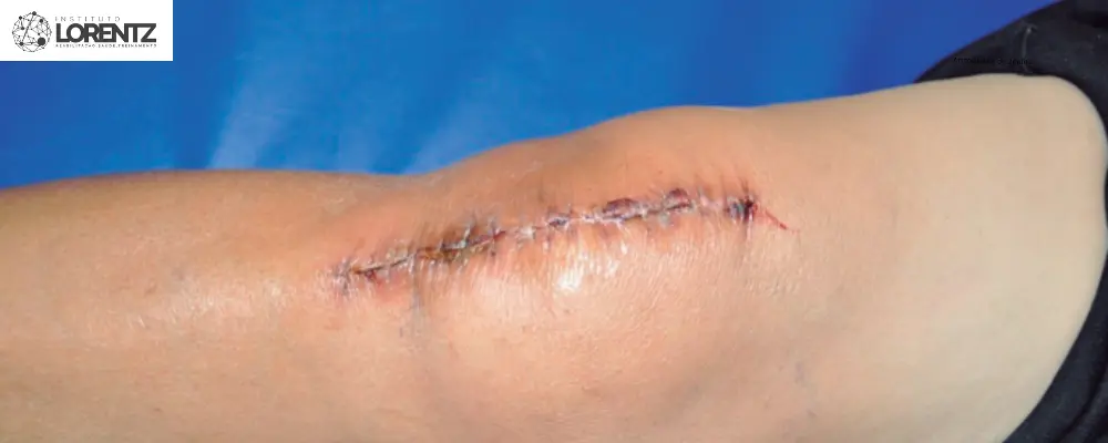 Fisioterapia Após Artroplastia de Joelho 3 Fisioterapia Após Artroplastia de Joelho
