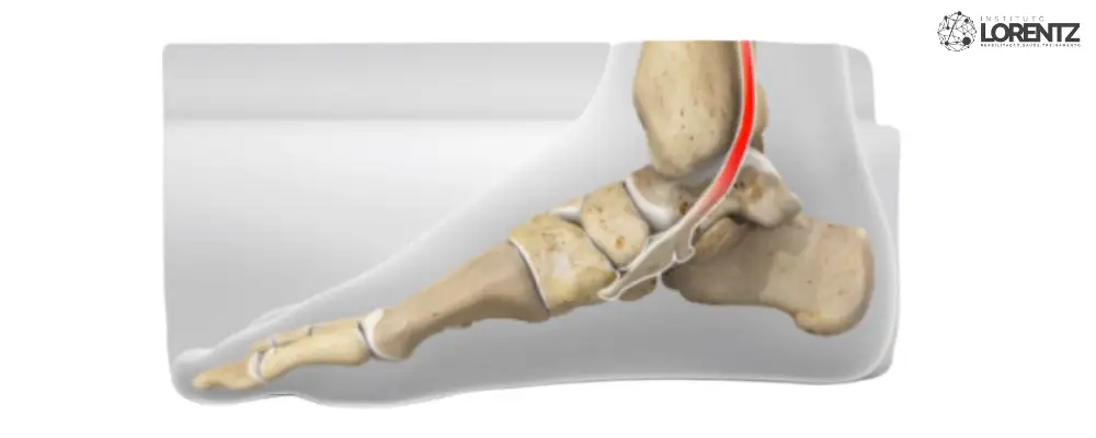 Tendinite do Tibial Posterior