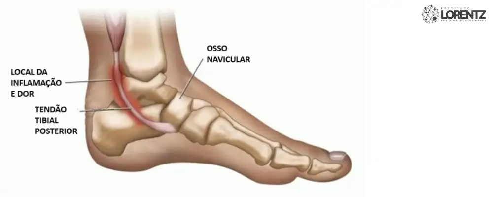 Tendinopatia do Tibilal Posterior