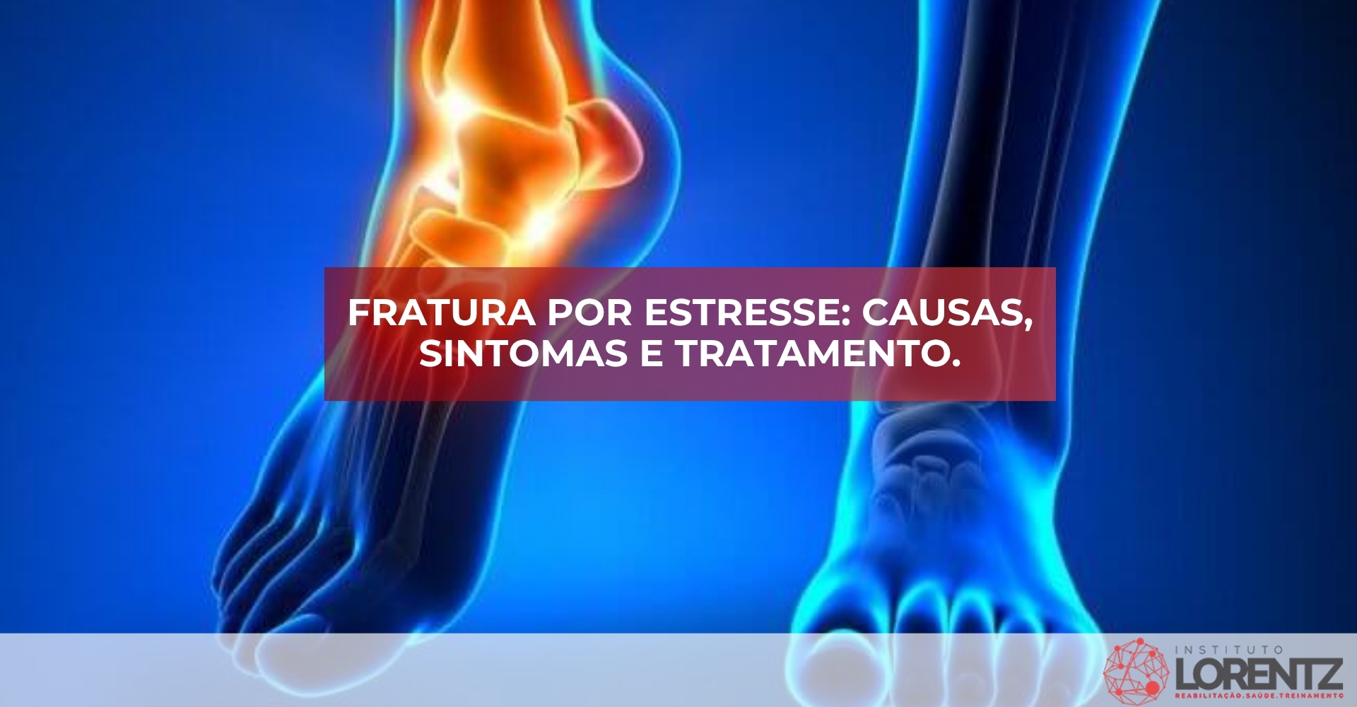 Fratura/por/estresse/Causas/sintomas/e/tratamento.