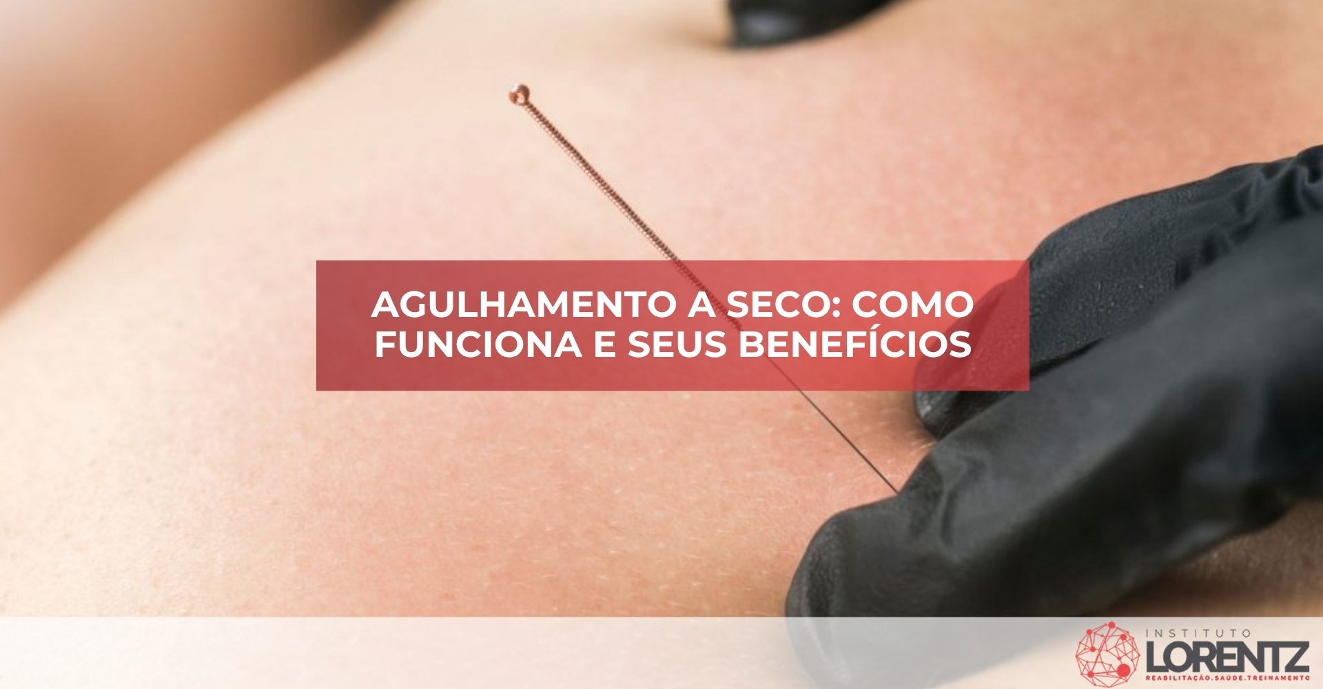 Agulhamento/a/Seco/Co/o/Funciona/e/Seus/Benefícios